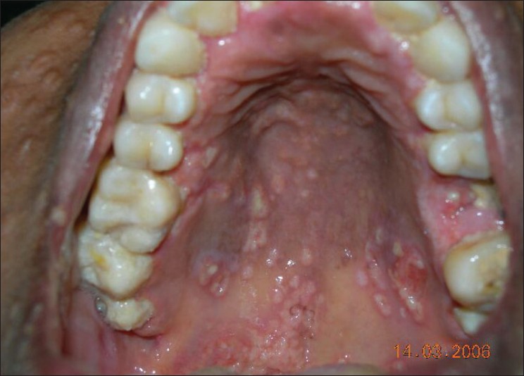 Mycology Reference Laboratory Transforms Outcomes Of Histoplasmosis In French Guiana Gaffi 6652