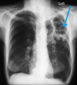 An example of severe CPA in the upper left lung (arrow) with fluid in the cavity