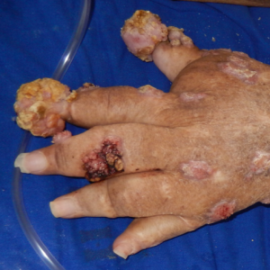 Chromoblastomycosis