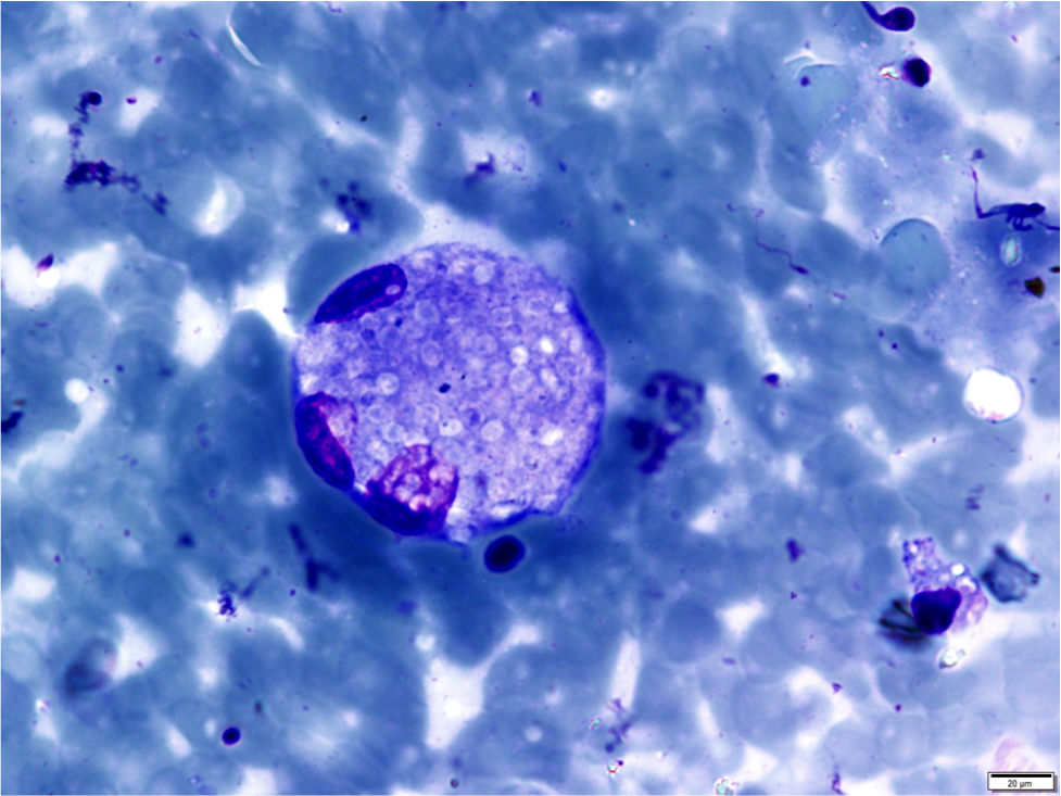 Histoplasmosis (intracellular)