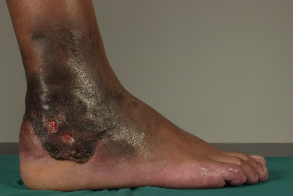 Mycetoma of the foot