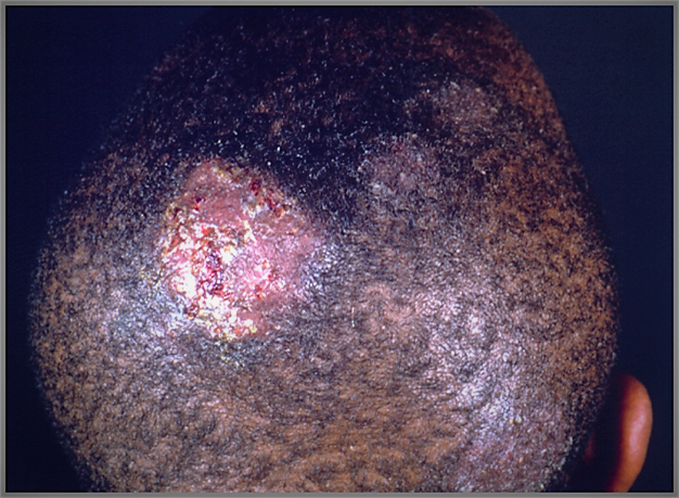 138 million school age children in Africa have fungal scalp infection,  affecting education and leading to social stigmas, medical experts say. -  Gaffi | Gaffi - Global Action For Fungal Infections
