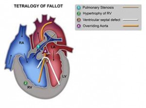 birth defect tetralogy