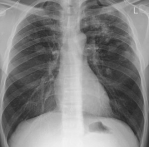 chest XrayTB