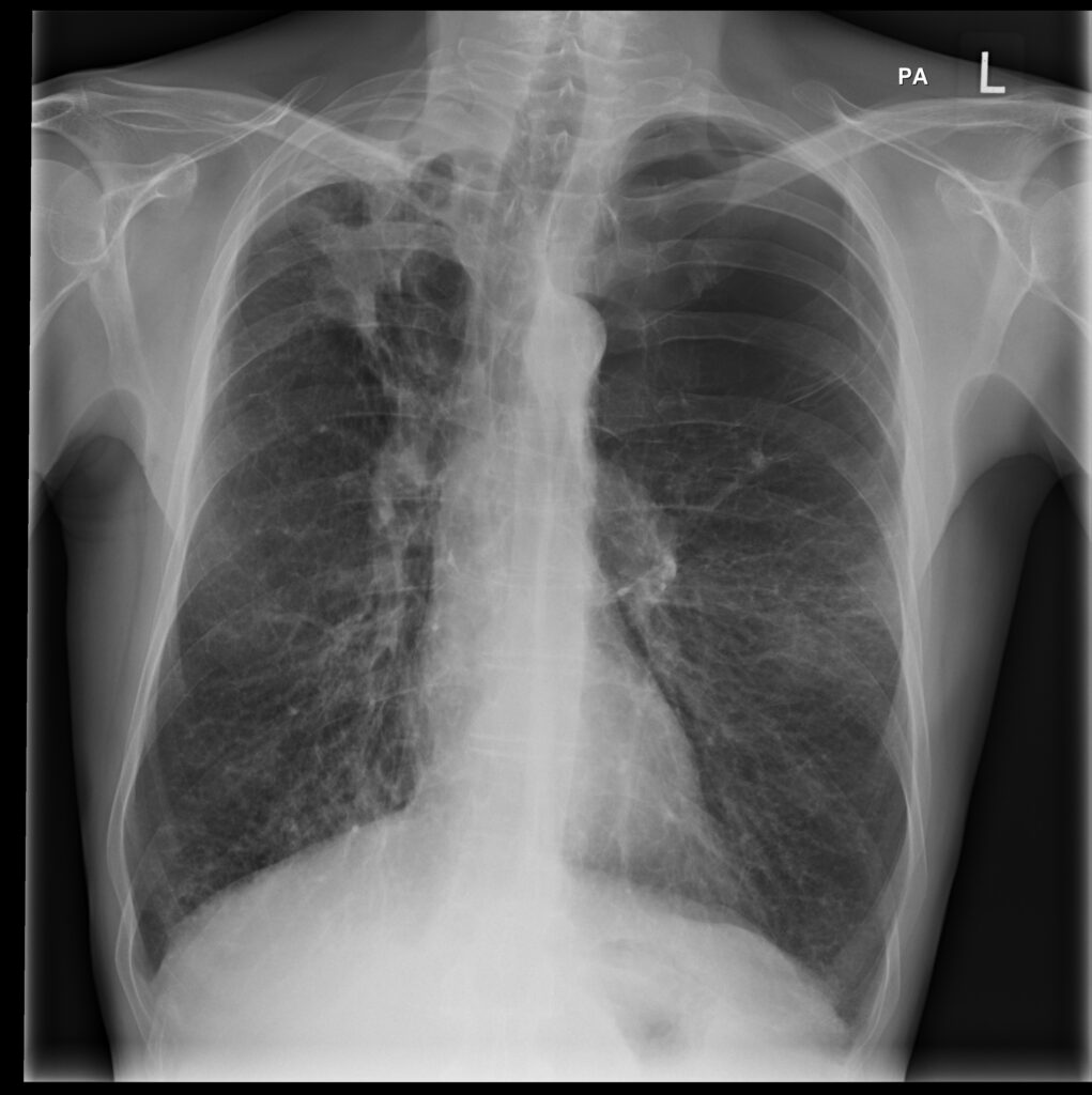 aspergillosis