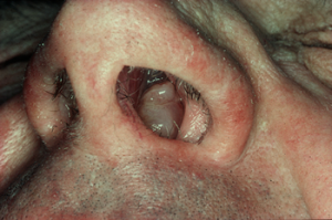 fungus in sinus cavity symptoms