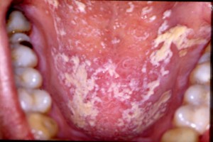 oral candidiasis
