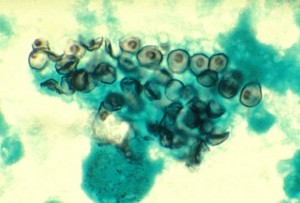 pneumocystis