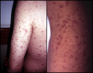 skin lesions histopl